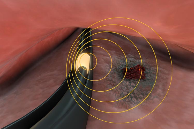 پرتودرمانی به دو روش اصلی خارجی و داخلی انجام می‌شود.